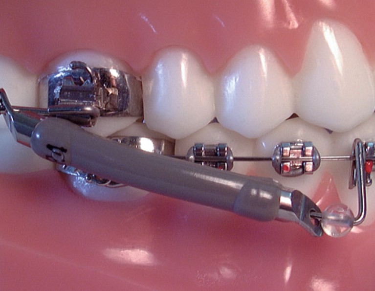 Fixed & Functional  American Orthodontics